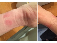 想買Apple Watch？小心皮膚過(guò)敏發(fā)紅！